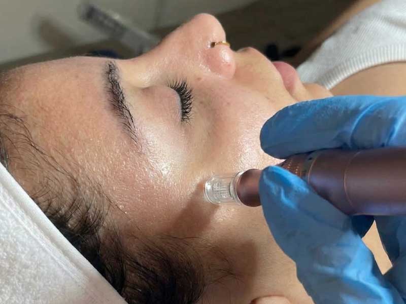 Microneedling