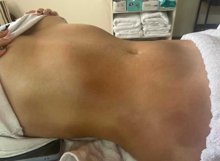 Después del Drenaje