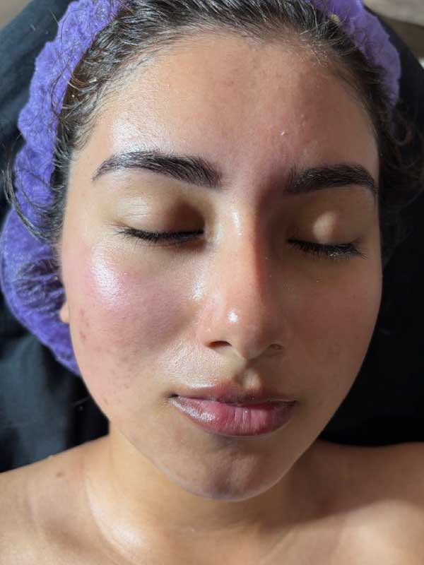 Limpieza Facial Profunda