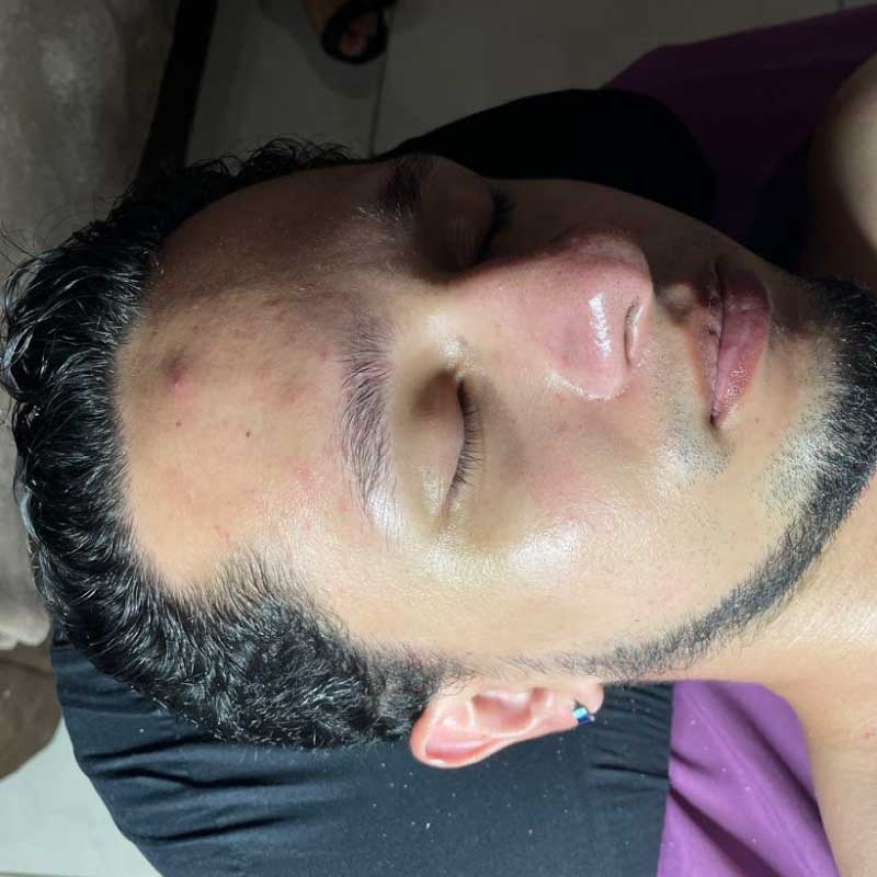 Antes del tratamiento