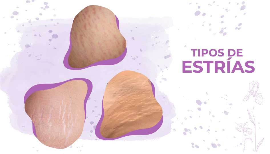 tipos de estrias